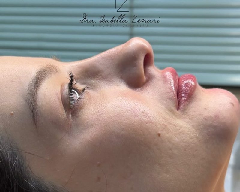 Depois da perfiloplastia feminina