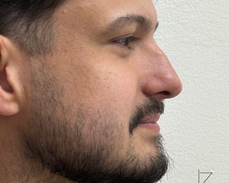 Antes da perfiloplastia masculina