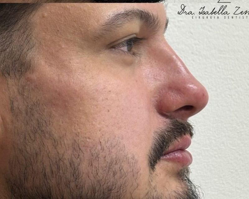 Depois da perfiloplastia masculina